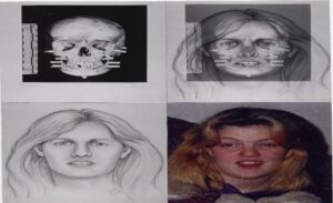 Facial Reconstruction