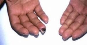 How Fingerprints are Collected on Different Diseases