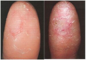 How Fingerprints are Collected on Different Diseases