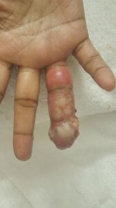 How Fingerprints are Collected on Different Diseases