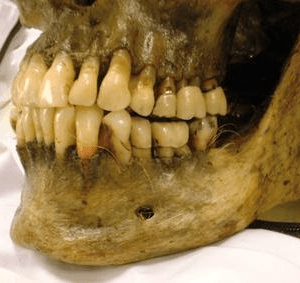 Forensic Odontology