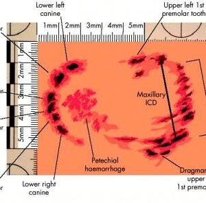 Bite Marks Analysis