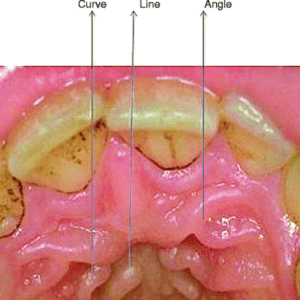 Palatal Rugae Analysis